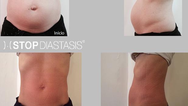 Abdomen distendido despues embarazo